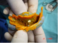 /album/galeria-de-fotos-carga-imediata-apos-exodontia-atraumatica-/carga-imediata-com-exodontia-atraumatica9-jpg/